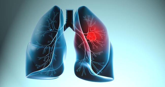 Erken Tanı Hayat Kurtarıyor! Akciğer Kanserini Bile Yenilebilir