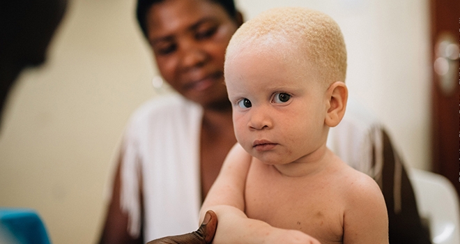 Dünya Albinizm Farkındalık Günü'nde “Beyaz Melekler”e Destek Olun