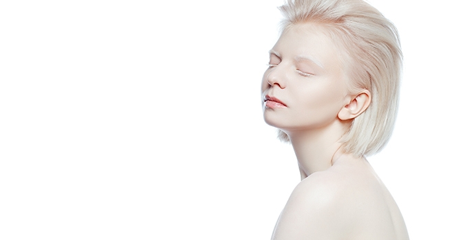 Beyaz Melek Albinolar Ve Görme Kusurları