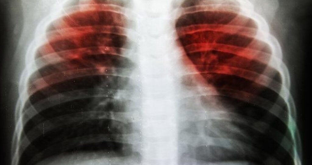 "Tüberküloz (Verem), İnsandan İnsana Bulaşan Bir Hastalık"