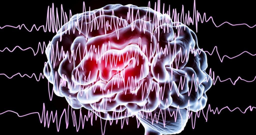 Epilepsi Hakkında Bilinmesi Gereken 9 Önemli Nokta